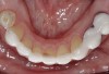 Figure 14. Mandibular veneer intraorally.