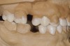 Figure 16 THROUGH 19. Complete full mouth wax-ups after final determination of 3D VDO.