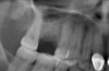 (1.) Radiograph of the missing maxillary molar and available bone between the crest and maxillary sinus.