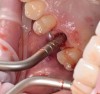 (10.) Osteotome utilized to press the plug into the osteotomy, filling the space created between the sinus floor and the sinus membrane.