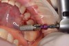 (11.) A 5.2 x 10 mm implant on a carrier, ready to be inserted into the site with the surgical handpiece.