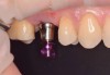 (12.) Implant with attached mount inserted into the osteotomy to proper depth in relation to the site’s osseous crest, the gingival margin, and the cementoenamel junction of the adjacent teeth.
