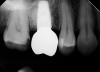 (14.) Radiograph at 36 months posttreatment, demonstrating maintenance of crestal bone level and height of the augmented sinus.