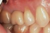 (15.) Clinical photograph at 36 months posttreatment, demonstrating stability of the gingival margin and absence of gingival inflammation around the restoration.