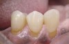 (Figure 3.) Gingival recession with exposed root surfaces are susceptible to dentinal hypersensitivity non-carious cervical lesions on the facial surfaces of mandibular teeth with symptoms of dentin hypersensitivity and in need of restorations