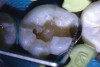 (4.) Preparation of tooth No. 19 with 4-mm distal box.