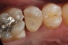 (9.) Core build-up on tooth No. 13 completed.