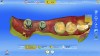 Fig 9. CEREC (Sirona) virtual model of scan post/scan body for teeth No. 30 and No. 31.