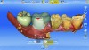 Fig 10. CEREC design file for custom abutment and crown for teeth No. 30 and No. 31.