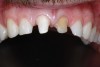 Fig 9. Plan to restore the maxillary lateral incisors and canines with porcelain veneers.