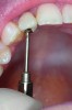 Figure 3. A 1-mm diameter screw used to retained crown.