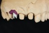 Figure 7. Zirconia abutment No. 7.