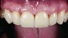 Figure 8. Final restorations showing good esthetic results and good soft-tissue integration.