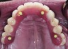 Figure 10. Immediate-load maxillary arch. The prosthesis is screw-retained.