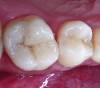 Figure 22. The postoperative result demonstrates the integrity of the bond and an optimal marginal adaptation to the tooth structure at the restorative interface using the adhesive design concept.