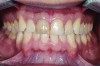 Figure 3. Gingival and papilla levels.