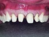 Figure 5. Preparation for crowns and veneers.