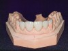 Figure 7. Crowns and veneers on model.