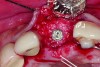 Placement of implant. Notice the bucco-palatal bone thickness gained from the ridge preservation technique.