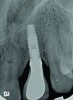 Radiograph of this same area. Note that there is no indication of bone loss and a long abutment collar. Hence, the diagnosis of peri-implant mucositis is given.