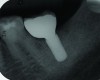 Radiograph of a mandibular left first molar implant in a 61-year-old man taken 2 years after the implant’s placement. No bone loss beyond physiologic remodeling has occurred.