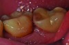 Clinical view of this area suggests that peri-implant mucositis is present, as there is bleeding on light probing and inflammation of the tissue.
