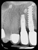 Fig 5. Radiograph 6 years after peri-implantitis repair (2014).