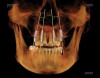 Figure 6 Implants and abutments placed, with the model turned off and the CBCT in view.