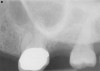 (2.) Radiograph of PAO showing necrotic tooth with sinus pathosis obscured by the zygoma.