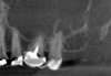 (6.) Preoperative CBCT image showing periapical pathosis of tooth No. 2 in communication with the sinus.