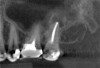 (7.) Postoperative CBCT images taken 3 months after NSRCT (ie, 6 weeks after sinus surgery), showing sinus clearing and reduction in the size of the PAO lesion.