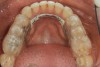 (3.) Preoperative occlusal view of lower arch with orthotic in place.