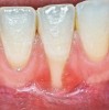 (1.) Pretreatment view of single incisor with gingival recession exposing the root.