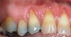 (3.) Pretreatment view of recession affecting multiple maxillary teeth.