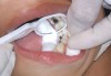 Darkened teeth after silver diamine fluoride treatment. Photos courtesy of Dr. Travis Nelson.