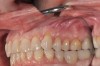 (9.) Gingival recession defect in Quadrant 1.