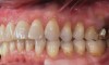 (11.) Gingival recession defect in Quadrant 2.