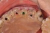 (23. AND 24.) Virtual restoration design and conventional surgical guide illustrating rudimentary entry points that do not allow control of drilling angulation and depth.