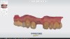 (29.) Preoperative view of missing tooth No. 8.