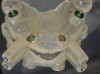 (35.) Manufactured surgical guide that utilizes both the anterior bone and posterior teeth for support.