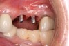 (14.) Integration confirmation on Nos. 12 and 13 at 6 months with temporary abutments and good soft tissue maturation.