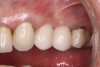 (15.) Clinical view of final individual crowns on Nos. 12 and 13.