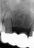 (17.) Case 3 initial radiograph of bridge on Nos. 6 through 9 and crown on No. 10.