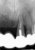 (18.) Case 3 initial radiograph of bridge on Nos. 6 through 9 and crown on No. 10.