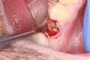 Fig 4. Atraumatic extraction of the hopeless tooth.