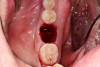 Fig 6.The socket must be bleeding before delivering the graft material. This facilitates the healing cascade and greatly increases the success of the socket preservation.