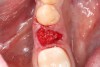 Fig 8. Delivery of the allograft material to the fresh bleeding socket.