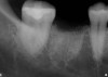 Fig 11. Radiograph of a socket graft after placement.