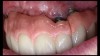 (16.) Photograph of failing implant prosthetics that may require specialty care taken with a smartphone and an EALS device.