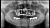 (17.) Photograph of failing implant prosthetics that may require specialty care taken with a smartphone and an EALS device.